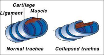 normal trachea vs. a collapsed trachea