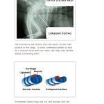 tracheal collapse chihuahuas