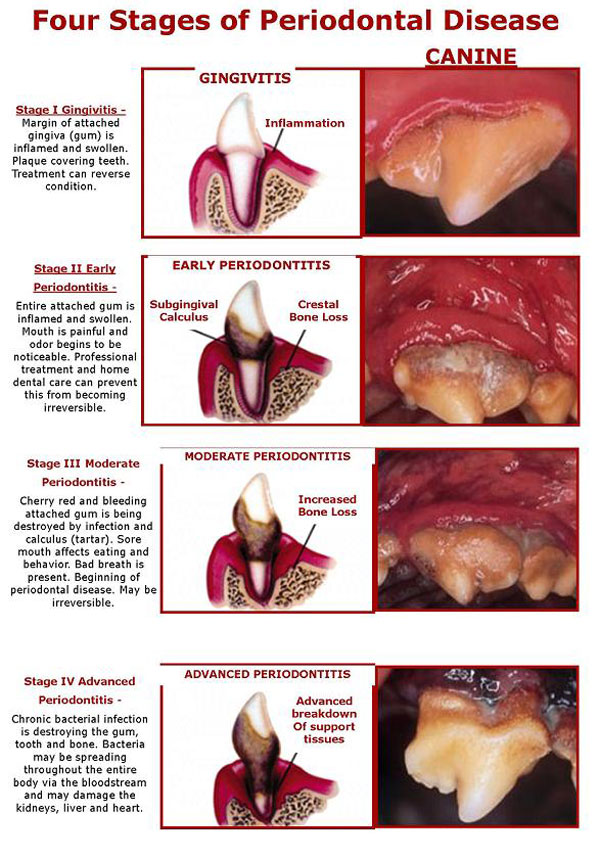 the four stages of periodontal disease